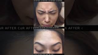 Neuromodulators by Dr. Kumar at CüR Laser and Skin ✨