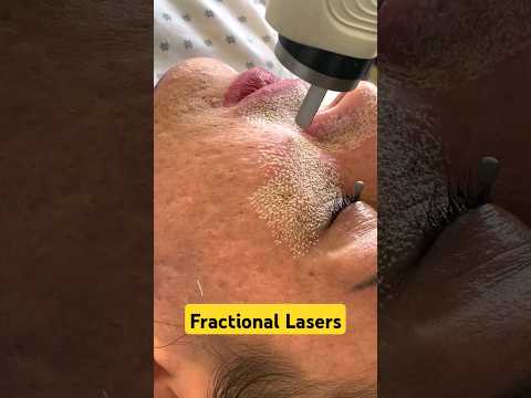 Laser Treatments for Face | Pimples and Acne Scar Laser Treatments #shorts #DMC