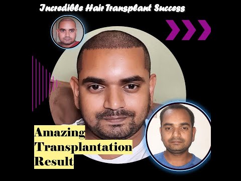 Hair Transplant Result after 1 month : Unrealistic hairline and density : Day 0 to Day 30