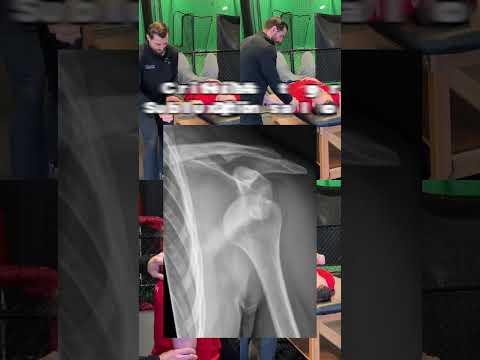 Multidirectional Shoulder Instability (MDI) Clinical Examination