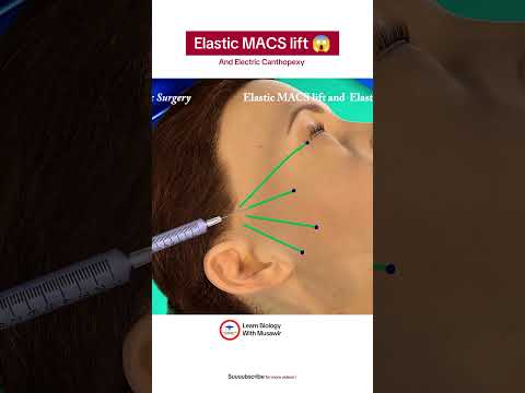 Elastic MACS lift and Elastic Canthopexy #surgery