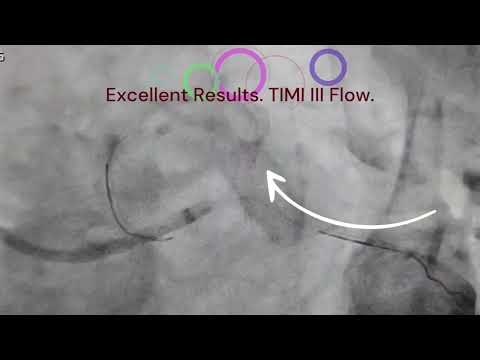 Angioplasty with Thrombus Aspiration