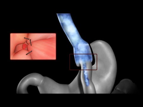 TORe Procedure with Apollo Revise™ System - IBI Healthcare