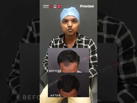 Transforming Hair Loss into Hair Gains: Patient Testimonial! | HairMD Clinic, Pune