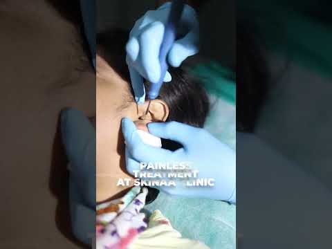 Earlobe Repair Treatment at Skinaa Clinic | #viralshorts  #skinaaclinic