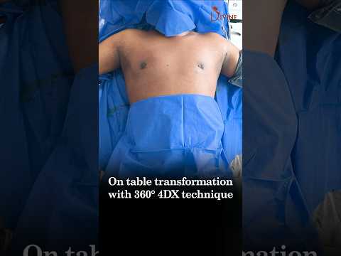 Gynecomastia Grade 2A: Get a Sculpted Chest with 360° 4Dx! On Table Result