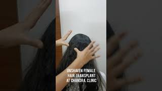 unshaven Female hair transplant Dr.Urvashi Chandra bio-IPT TECHNIQUE #fue  #femalehairtransplant