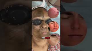 Carbon Laser Treatment at Twacha Aesthetic 💫