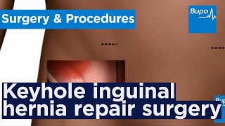 How keyhole inguinal hernia repair surgery is carried out | Bupa Health