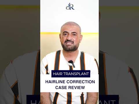 Hairline Correction Success Story! #drranairfan #hairtransplant #hairtransplantresults #fyp #shorts