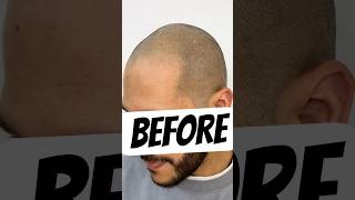 BEST SCALP MICROPIGMENTATION ARTIST IN USA? #smp #pmu #fue