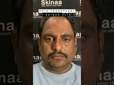 HAIR TRANSPLANT BEFORE AFTER AT SKINAA CLINIC #viral