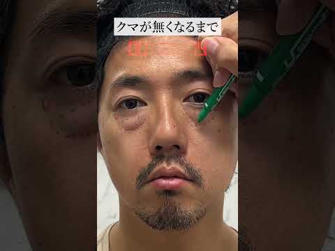 【クマ治療】40代のクマ取り劇的ビフォーアフター#クマ取り #目の下のクマ取り #目の下のクマ #shorts