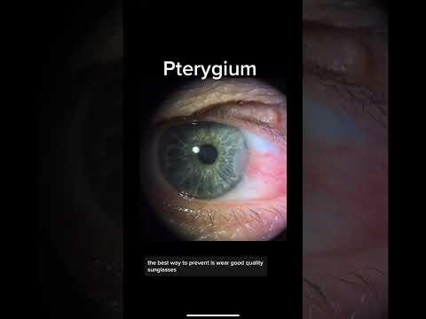 Pterygium, caused by sun damage and can be prevented by good quality sunglasses!