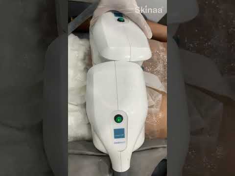 Fat Freezing Treatment at Skinaa Clinic | Achieve Your Dream Body with Advanced Technology #viral