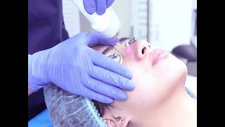 Acne Issue: Cystic Acne