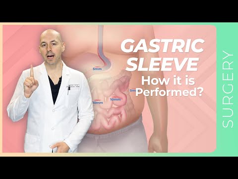 Gastric Sleeve. The MOST USED SURGERY in the WORLD to Lose Weight!