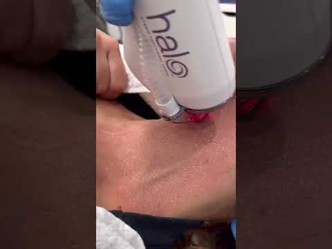 Improving neck tone and texture with Halo laser resurfacing!