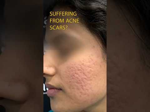 Acne Scar Treatment: Clear & Smooth Skin with Skinaa Clinic | Real Transformation #youtube #shorts