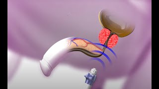 Prostate Disorders Treatment - BTL Shockwave Therapy