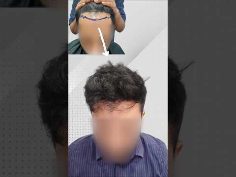 Receding Hairline to Full Hair |  8-Month FUT Hair Transplant Transformation