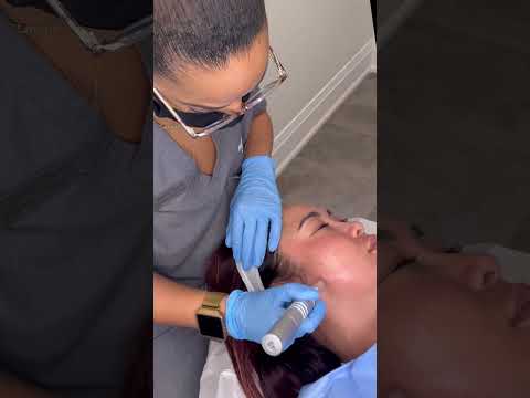 #microneedling #torontolife #avebelle
