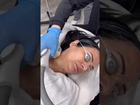 Broadband Light SkinTyte!#torontoskintightening #torontolifestyle