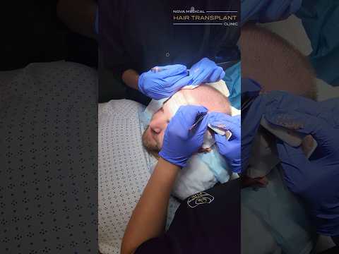 🌟Behind the Scenes: 3000 Grafts FUE Surgery in New Jersey / #hairsurgery #fuehair #hairregrowth