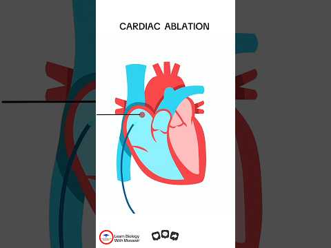 Cardiac Ablation  #cardiology