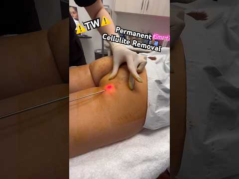 Permanent cellulite removal is finally here 🤩✨ Call us for a consult (909) 466-1234 #cellulite