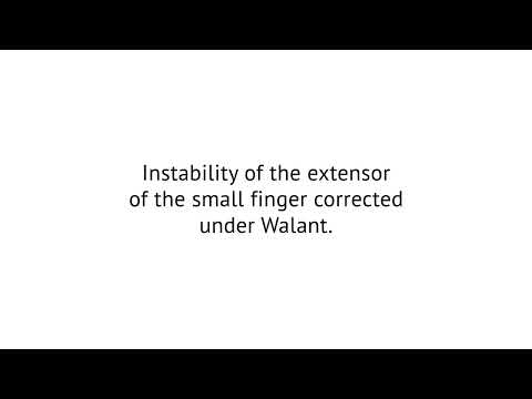 The underlying cause was Dupuytren’s disease of the small finger.