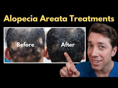 Most Effective Alopecia Areata Treatments