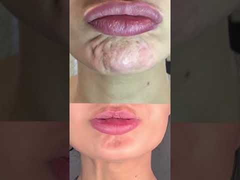 Did you know Botox can improve the look of orange peel skin on the chin!? #botoxchin #torontobotox