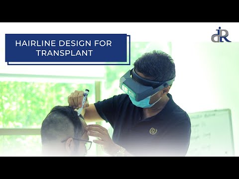 How to Draw Hairline for Hair Transplant | Perfect Hairline for Hair Transplant | Dr Rana Irfan