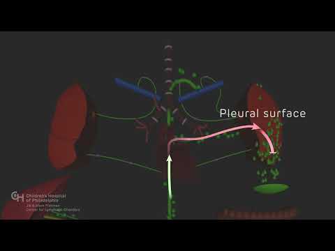 Chylothorax