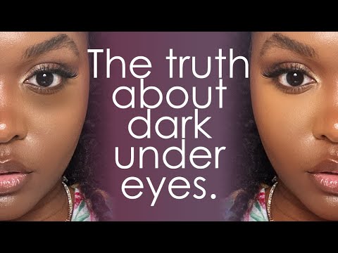 TREATING DARK CIRCLES & PUFFY UNDEREYES - Causes & Treatments, An Esthetician's Guide