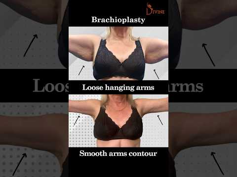 Say Goodbye to Flabby Arms! Arm Lift for Tight, Toned Contours | Brachioplasty