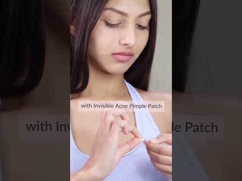 Pimples, Meet Your Worst Enemy. (Good Luck.)