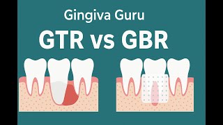 GTR vs GBR | Gingiva Guru Ep. 2 | Periodontics Simplified