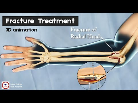 Fracture of the Radial head | 3D animation