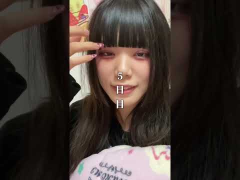 【二重整形】埋没をしてから1週間…ダウンタイムはこんな感じでした #shorts