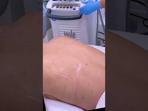 Broadband Light (BBL) ⚡️#pigmentation #torontoblogger #torontomedspa#backacne #backspots  #avebelle