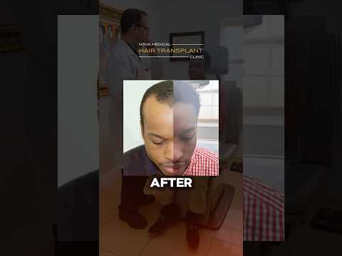 🔥Reclaiming Confidence: Hair Transplant Before & After / #hairtransplantresults #fuehair