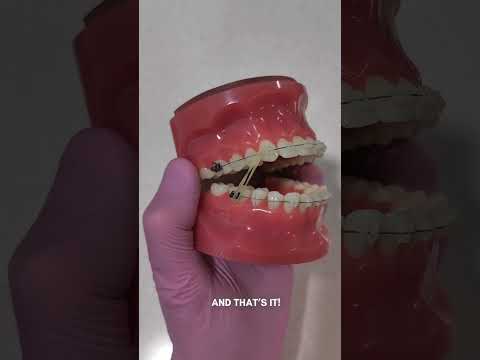 How to use Elastics on your braces