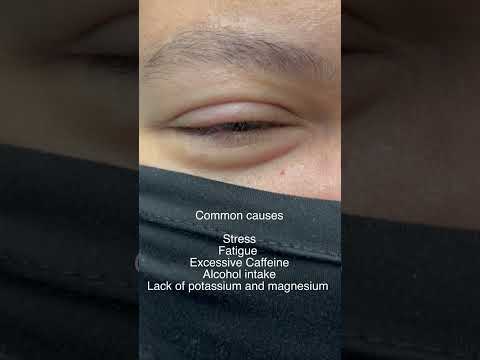 Myokemia or Eyelid Twitch