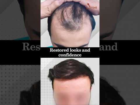 Hair Restoration | Hair Transplant Result– Full Hair in 10 Months!