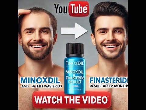 Minoxidil and finasteride results after 2 months - amazing #minoxidilresult #rogaine #finasteride