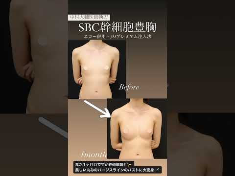 【脂肪豊胸】SBC幹細胞豊胸がおすすめ　 #豊胸 #美容 #湘南美容クリニック #美容整形 #脂肪豊胸 #爆乳　 #整形