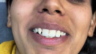 Upper lips waxing by rica wax/How to do upper lip waxing  #upperlipswaxing #waxing #pummybeautyworld