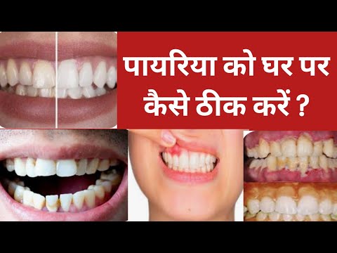 पायरिया को घर पर कैसे ठीक करें ?l pyorrhea ko thik karne ke gharelu upchar ll home remedies for